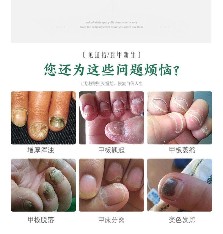 灰指甲液oem貼牌產品
